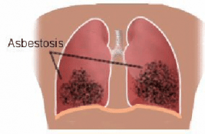 Asbestosis