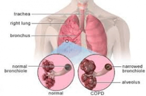 Lungs COPD