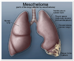 mesothelioma