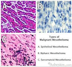 types-of-malignant-mesothelioma